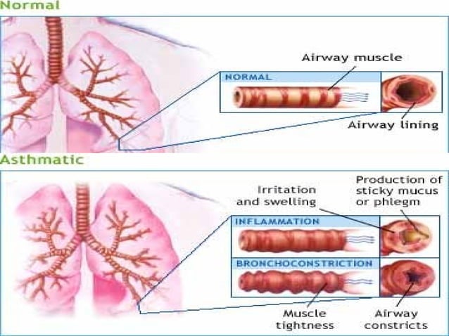 Status asthmaticus PPT