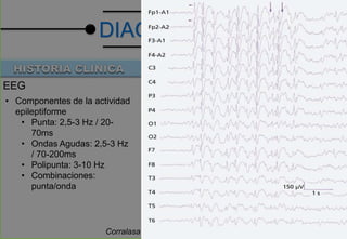 Corralasa L. Estatus epiléptico. Med Intensiva. 2008;32(4):174-82
DIAGNOSTICO
EEG
• Componentes de la actividad
epileptiforme
• Punta: 2,5-3 Hz / 20-
70ms
• Ondas Agudas: 2,5-3 Hz
/ 70-200ms
• Polipunta: 3-10 Hz
• Combinaciones:
punta/onda
 