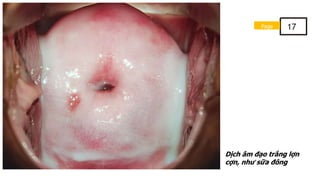 Dịch âm đạo trắng lợn
cợn, như sữa đông
Page 17
 