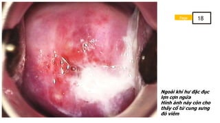 Ngoài khí hư đặc đục
lợn cợn ngứa
Hình ảnh này còn cho
thấy cổ tử cung sưng
đỏ viêm
Page 18
 