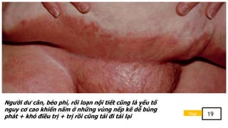 Người dư cân, béo phì, rối loạn nội tiết cũng là yếu tố
nguy cơ cao khiến nấm ở những vùng nếp kẽ dễ bùng
phát + khó điều trị + trị rồi cũng tái đi tái lại
Page 19
 