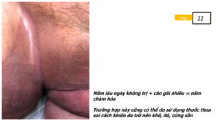 Nấm lâu ngày không trị + cào gãi nhiều ⇒ nấm
chàm hóa
Trường hợp này cũng có thể do sử dụng thuốc thoa
sai cách khiến da trở nên khô, đỏ, cứng sần
Page 22
 