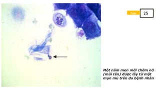 Một nấm men mới chớm nở
(mũi tên) được lấy từ một
mụn mủ trên da bệnh nhân
Page 25
 
