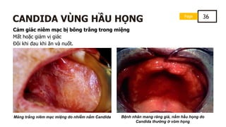 Page 36
CANDIDA VÙNG HẦU HỌNG
Cảm giác niêm mạc bị bông trắng trong miệng
Mất hoặc giảm vị giác
Đôi khi đau khi ăn và nuốt.
Mảng trắng niêm mạc miệng do nhiễm nấm Candida Bệnh nhân mang răng giả, nấm hầu họng do
Candida thường ở vòm họng
 
