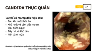 Page 37
CANDIDA THỰC QUẢN
Có thể có những dấu hiệu sau:
- Đau khi nuốt thức ăn
- Khó nuốt và cảm giác nghẹn
- Đau buồn ngực
- Đầy hơi và khó tiêu
- Nôn và ói mửa
Hình ảnh nội soi thực quản cho thấy những mảng bám
màu trắng do nấm Candida
 