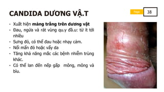 Page 38
CANDIDA DƯƠNG VẬ.T
- Xuất hiện mảng trắng trên dương vật
- Đau, ngứa và rát vùng qu.y đầ.u: từ ít tới
nhiều
- Sưng đỏ, có thể đau hoặc nhạy cảm.
- Nổi mẩn đỏ hoặc vẩy da
- Tăng khả năng mắc các bệnh nhiễm trùng
khác.
- Có thể lan đến nếp gấp mông, mông và
bìu.
 