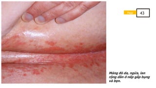 Mảng đỏ da, ngứa, lan
rộng dần ở nếp gấp bụng
và bẹn.
Page 43
 