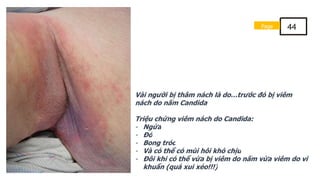 Vài người bị thâm nách là do…trước đó bị viêm
nách do nấm Candida
Triệu chứng viêm nách do Candida:
- Ngứa
- Đỏ
- Bong tróc
- Và có thể có mùi hôi khó chịu
- Đôi khi có thể vừa bị viêm do nấm vừa viêm do vi
khuẩn (quá xui xẻo!!!)
Page 44
 