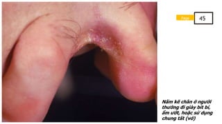 Nấm kẽ chân ở người
thường đi giày bít bí,
ẩm ướt, hoặc sử dụng
chung tất (vớ)
Page 45
 