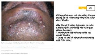 Không phải mụn mủ nào cũng là mụn
trứng cá và viêm nang lông nào cũng
do vi khuẩn.
Đây là một trường hợp viêm do nấm
Candida gây ra ở vùng râu nam giới
(tinea barbae):
- Thường do tiếp xúc trực tiếp với
người bị nấm
- Cũng có thể từ động vật nuôi trong
nhà (chó mèo)
Page 49
 