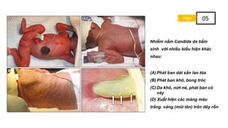 Nhiễm nấm Candida da bẩm
sinh với nhiều biểu hiện khác
nhau:
(A) Phát ban dát sẩn lan tỏa
(B) Phát ban khô, bong tróc
(C) Da khô, nứt nẻ, phát ban có
vảy
(D) Xuất hiện các mảng màu
trắng vàng (mũi tên) trên dây rốn
Page 05
 