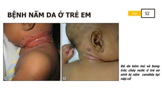 Page 52
BỆNH NẤM DA Ở TRẺ EM
Đỏ da kèm mủ và bong
tróc chảy nước ở trẻ sơ
sinh bị nấm candida tại
nếp cổ
 