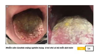 Page 54
Nhiễm nấm Candida miệng nghiêm trọng ở trẻ nhỏ có hệ miễn dịch kém
 