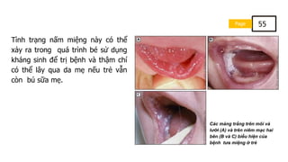 Page 55
Tình trạng nấm miệng này có thể
xảy ra trong quá trình bé sử dụng
kháng sinh để trị bệnh và thậm chí
có thể lây qua da mẹ nếu trẻ vẫn
còn bú sữa mẹ.
Các mảng trắng trên môi và
lưỡi (A) và trên niêm mạc hai
bên (B và C) biểu hiện của
bệnh tưa miệng ở trẻ
 