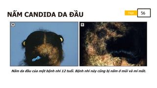 Page 56
NẤM CANDIDA DA ĐẦU
Nấm da đầu của một bệnh nhi 12 tuổi. Bệnh nhi này cũng bị nấm ở mũi và mí mắt.
 