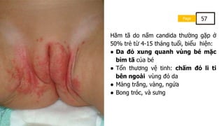 Page 57
Hăm tã do nấm candida thường gặp ở
50% trẻ từ 4-15 tháng tuổi, biểu hiện:
● Da đỏ xung quanh vùng bé mặc
bỉm tã của bé
● Tổn thương vệ tinh: chấm đỏ li ti
bên ngoài vùng đỏ da
● Mảng trắng, vàng, ngứa
● Bong tróc, và sưng
 