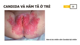 Page 58
CANDIDA VÀ HĂM TÃ Ở TRẺ
Hăm tã do nhiễm nấm Candida bội nhiễm
 