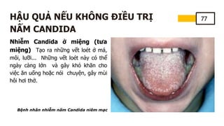77
HẬU QUẢ NẾU KHÔNG ĐIỀU TRỊ
NẤM CANDIDA
Nhiễm Candida ở miệng (tưa
miệng) Tạo ra những vết loét ở má,
môi, lưỡi... Những vết loét này có thể
ngày càng lớn và gây khó khăn cho
việc ăn uống hoặc nói chuyện, gây mùi
hôi hơi thở.
Bệnh nhân nhiễm nấm Candida niêm mạc
 