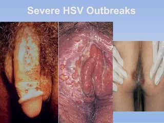 Severe HSV Outbreaks
 