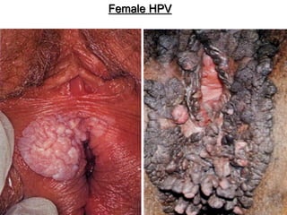 Female HPV
 