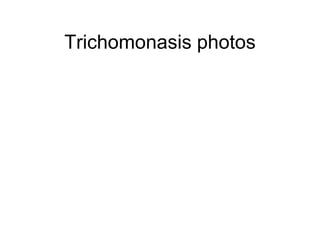 Trichomonasis photos
 