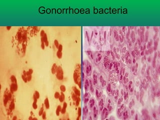 Gonorrhoea bacteria
 