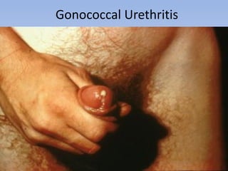 Gonococcal Urethritis
 