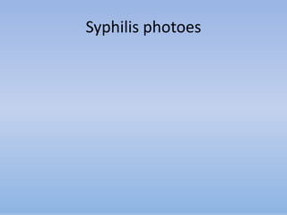 Syphilis photoes
 