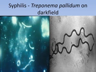 Syphilis - Treponema pallidum on
              darkfield
 