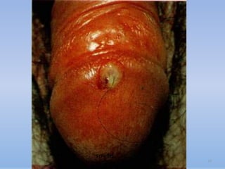 SYPHILIS
           77
 