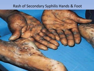 Rash of Secondary Syphilis Hands & Foot
 