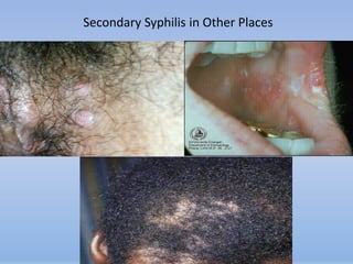 Secondary Syphilis in Other Places
 