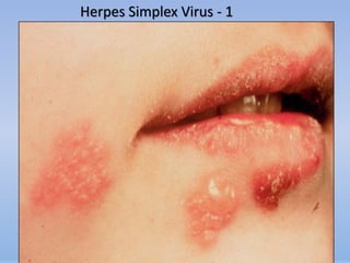 Herpes Simplex Virus - 1
 
