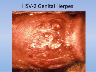 HSV-2 Genital Herpes
 