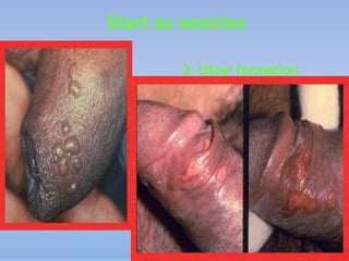 Start as vesicles

         2. Ulcer formation
 