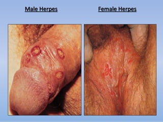 Male Herpes   Female Herpes
 