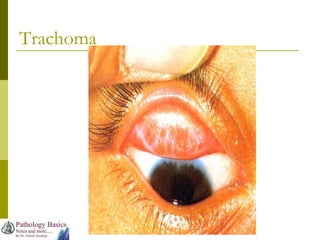 Trachoma
 
