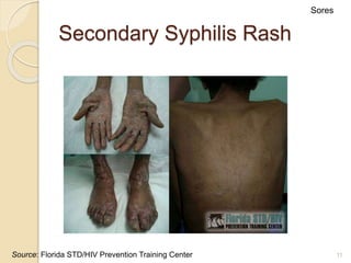 11
Secondary Syphilis Rash
Sores
Source: Florida STD/HIV Prevention Training Center
 