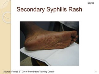12
Secondary Syphilis Rash
Sores
Source: Florida STD/HIV Prevention Training Center
 