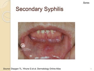 13
Secondary Syphilis
Sores
Source: Diepgen TL, Yihune G et al. Dermatology Online Atlas
 