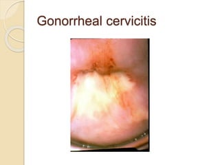 Gonorrheal cervicitis
 