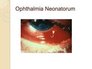 Ophthalmia Neonatorum
 