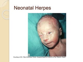 Neonatal Herpes
Courtesy of Dr. Félix Omeñaca Terés, Hospital Materno Infantil La Paz, Madrid, Spain
 