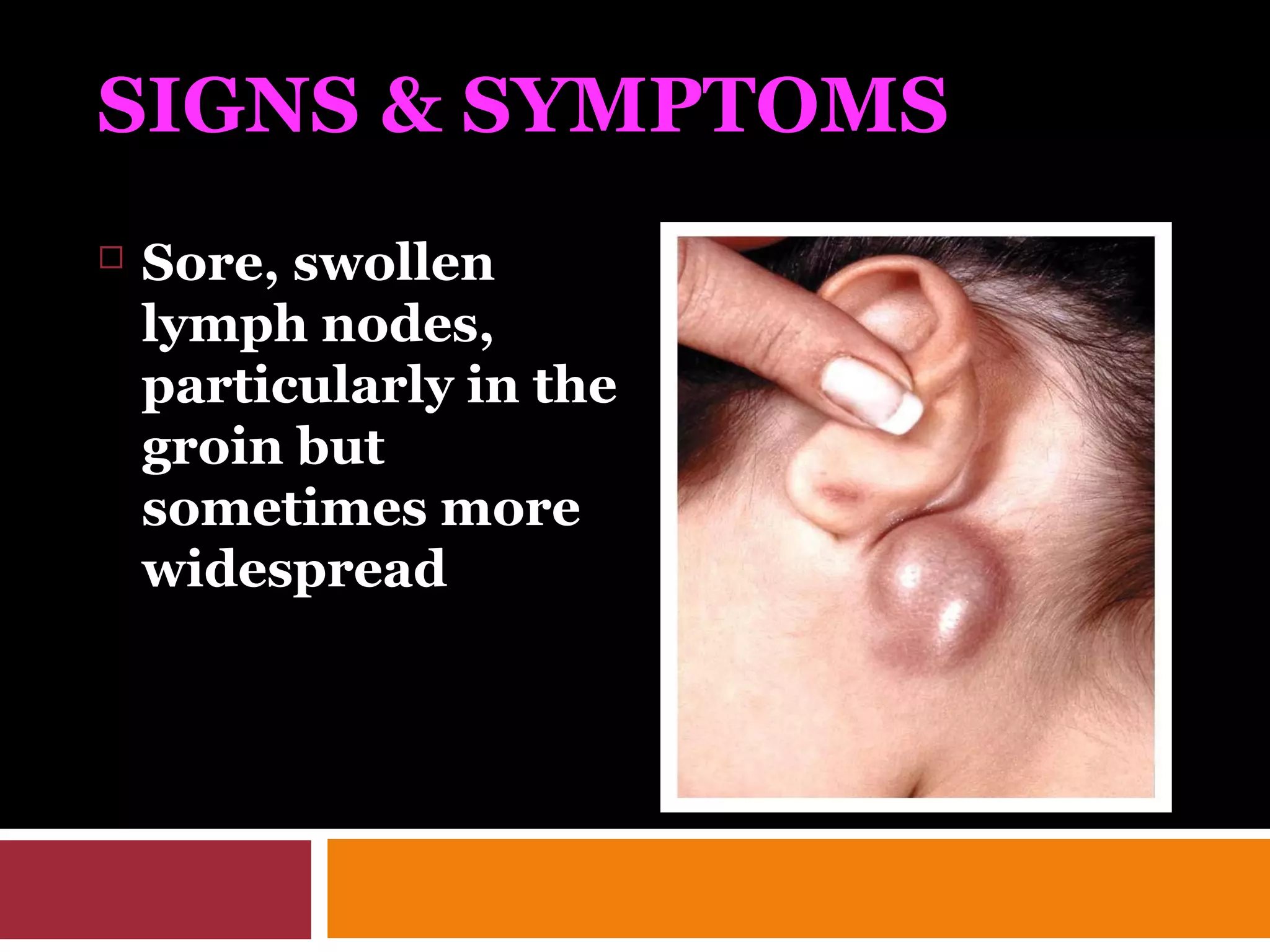 SIGNS & SYMPTOMS
 Sore, swollen
lymph nodes,
particularly in the
groin but
sometimes more
widespread
 