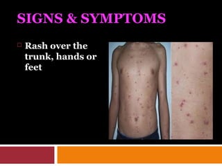 SIGNS & SYMPTOMS
 Rash over the
trunk, hands or
feet
 