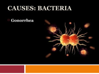 CAUSES: BACTERIA
 Gonorrhea
 