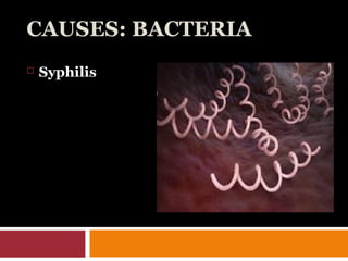 CAUSES: BACTERIA
 Syphilis
 