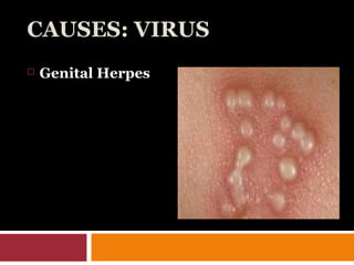 CAUSES: VIRUS
 Genital Herpes
 