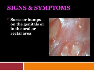 SIGNS & SYMPTOMS
 Sores or bumps
on the genitals or
in the oral or
rectal area
 