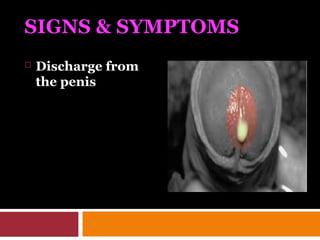 SIGNS & SYMPTOMS
 Discharge from
the penis
 
